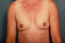 before breast augmentation front view female patient case 1262