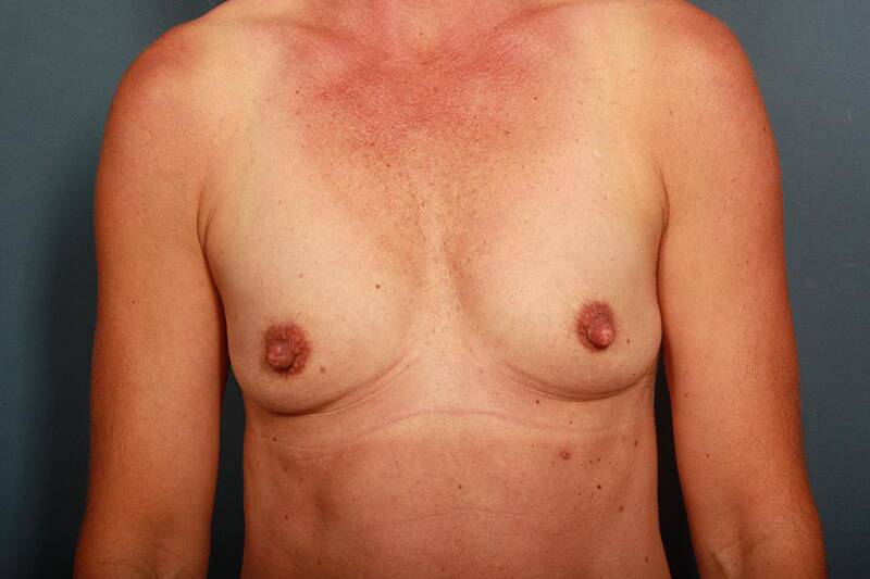 before breast augmentation front view female patient case 1262