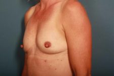 before breast augmentation left angle view female patient case 1262