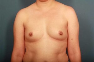before breast augmentation front view female patient case 1267