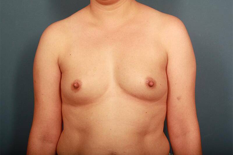 before breast augmentation front view female patient case 1267