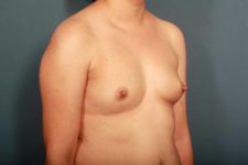 before breast augmentation left angle view female patient case 1267