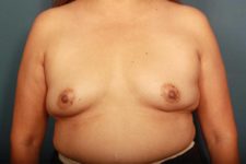 before breast augmentation front view female patient case 1272