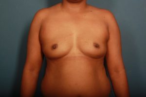 before breast augmentation front view female patient case 1286
