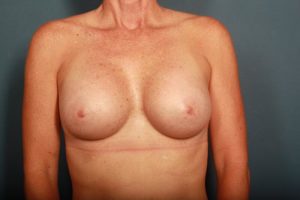 after breast augmentation front view female patient case 1292