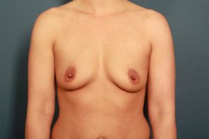 before breast augmentation front view female patient case 1332