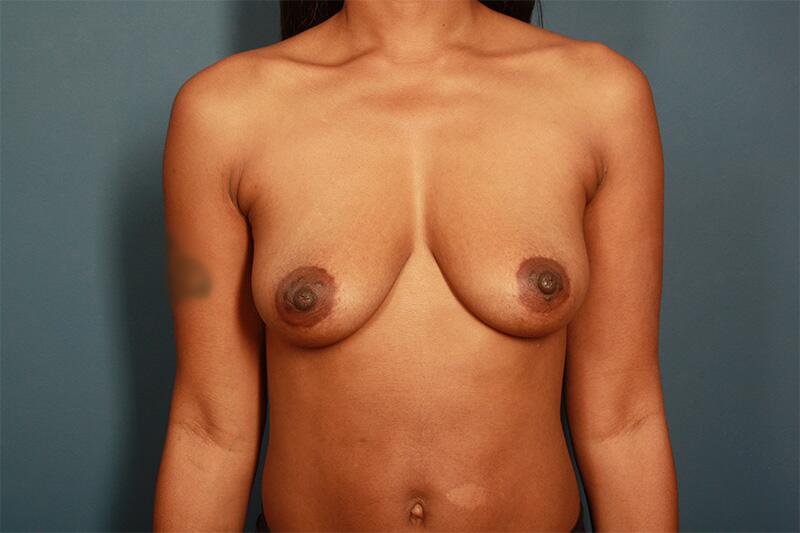 before breast augmentation front view female patient case 1343