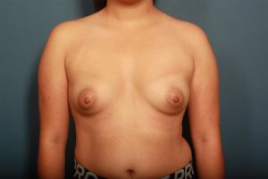 before breast augmentation front view female patient case 1353