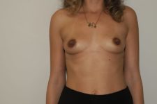 before breast augmentation front view female patient case 1382
