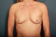 before breast augmentation front view female patient case 1420