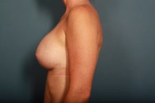 after breast augmentation left side view female patient case 1420