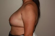 after breast augmentation left side view female patient case 1489