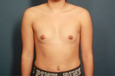before breast augmentation front view female patient case 1505