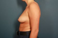 before breast augmentation left side view female patient case 1512