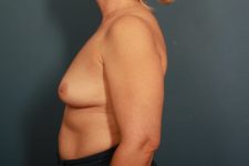 before breast augmentation left side view female patient case 1519
