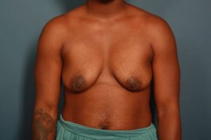 before breast lift front view female patient case 1123