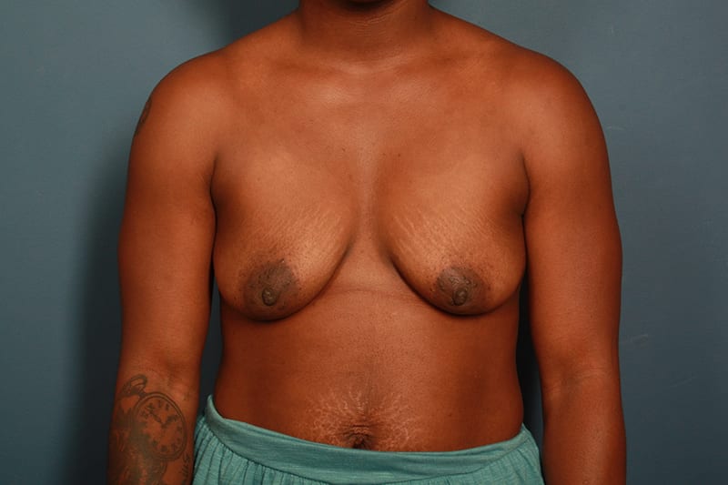 before breast lift front view female patient case 1123