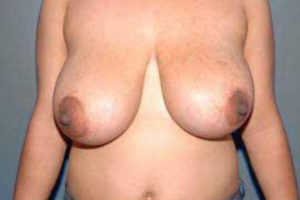 before breast reduction front view female patient case 1147