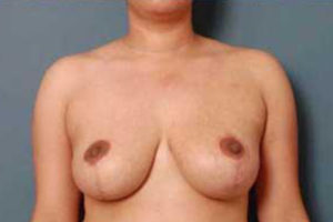 after breast reduction front view female patient case 1147