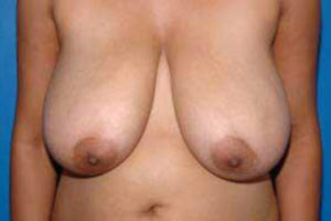 before breast reduction front view female patient case 1177