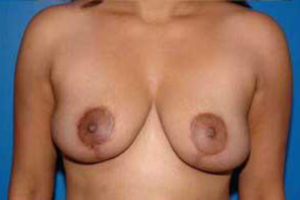 after breast reduction front view female patient case 1177
