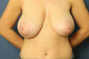 before breast reduction front view female patient case 1183