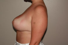 after breast reduction left side view female patient case 1199