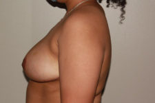 after breast reduction left side view female patient case 1210