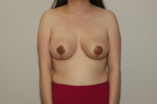 after breast reduction front view female patient case 1215