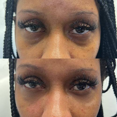 before and after dermal fillers closeup of eyes case 1599