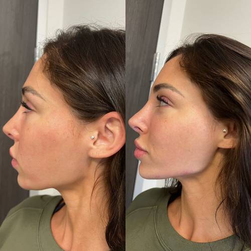 before and after dermal fillers left side view case 1601