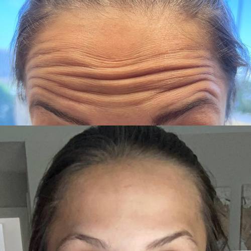 before and after dysport case 1603