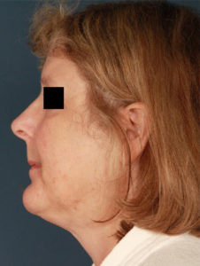 before facelift female patient left side view case 2228