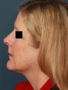 after facelift female patient left side view case 2228