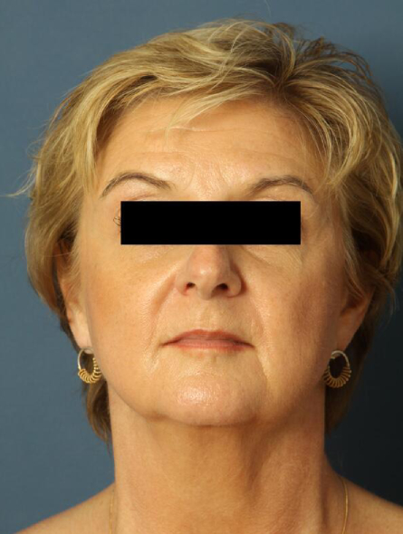 before facelift female patient front view case 2236