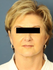 after facelift female patient front view case 2236