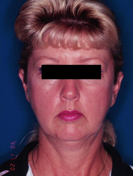 before facelift female patient front view case 2239