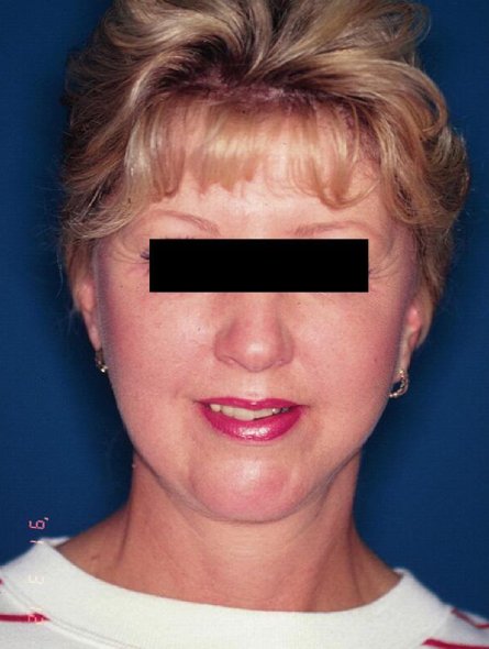 after facelift female patient front view case 2239