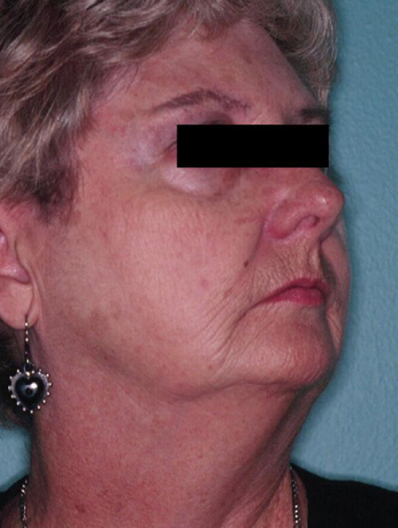 before facelift female patient right angled view case 2242