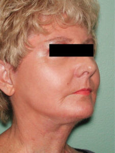 after facelift female patient right angled view case 2242
