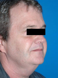before facelift male patient right angled view case 2245