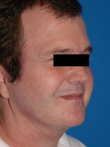 before facelift male patient right angled view case 2245