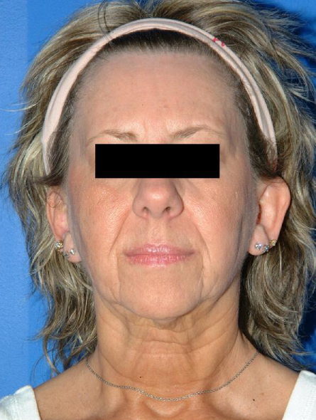 before facelift female patient front view case 2248