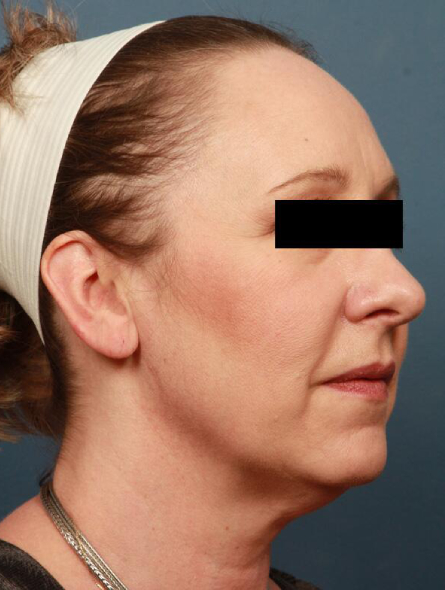 before facelift female patient front view case 2251