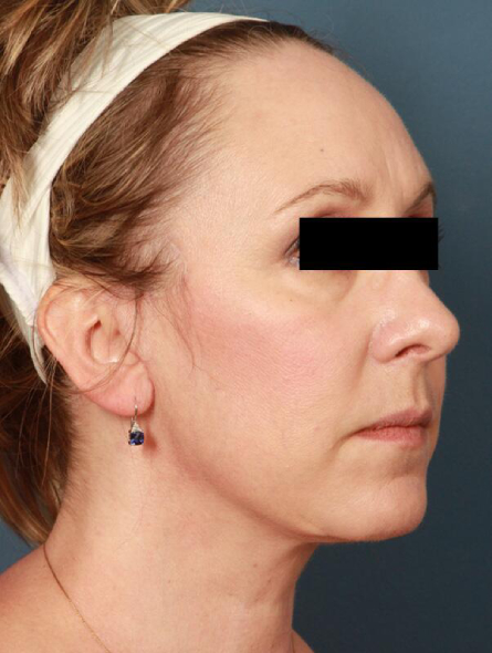 after facelift female patient right angled view case 2251