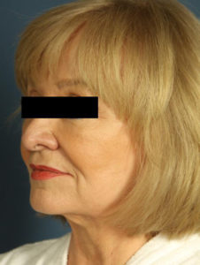 before facelift female patient left angled view case 2254
