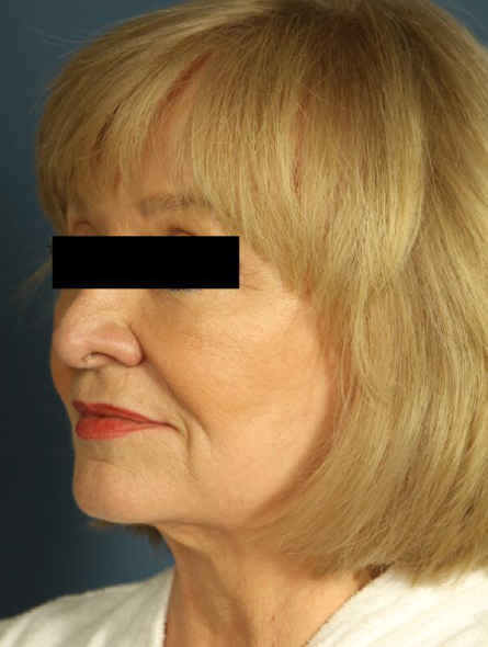 before facelift female patient left angled view case 2254