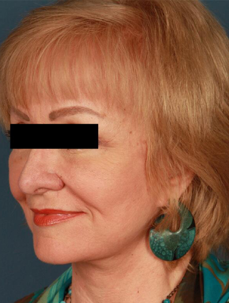 after facelift female patient left angled view case 2254