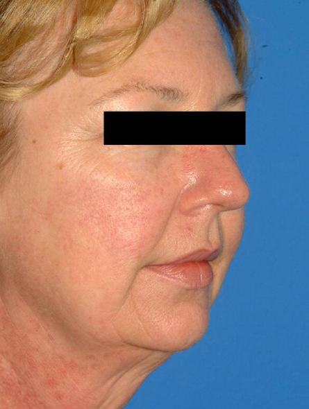 before facelift female patient right angled view case 2257