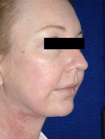 after facelift female patient right angled view case 2257